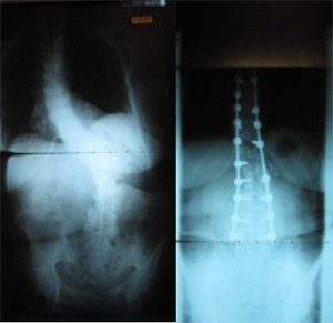 Surgical Options for Lumbar Stenosis